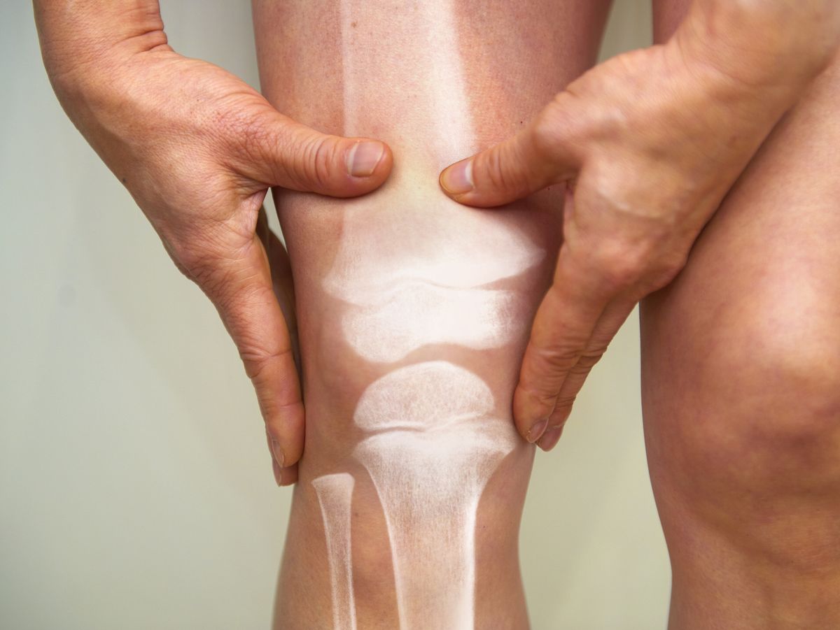 Qué comer para fortalecer las rodillas y prevenir lesiones