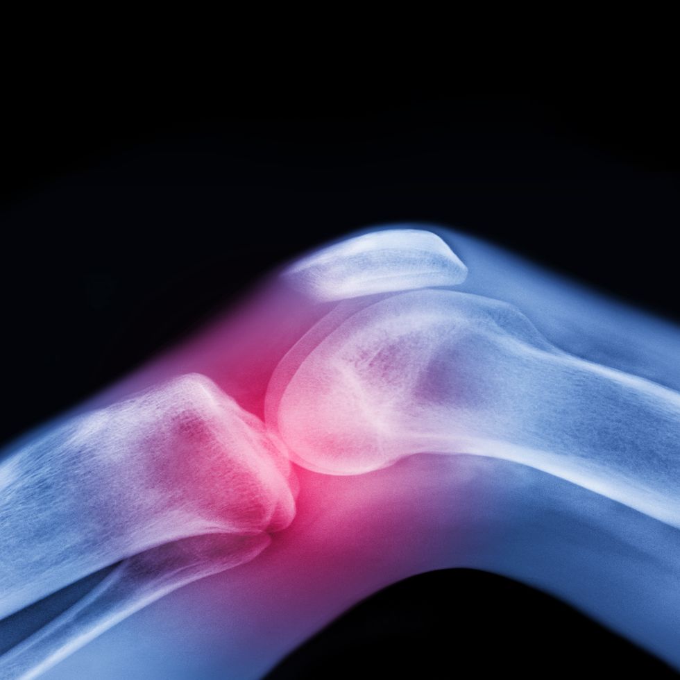 X-ray of knee with sports injury