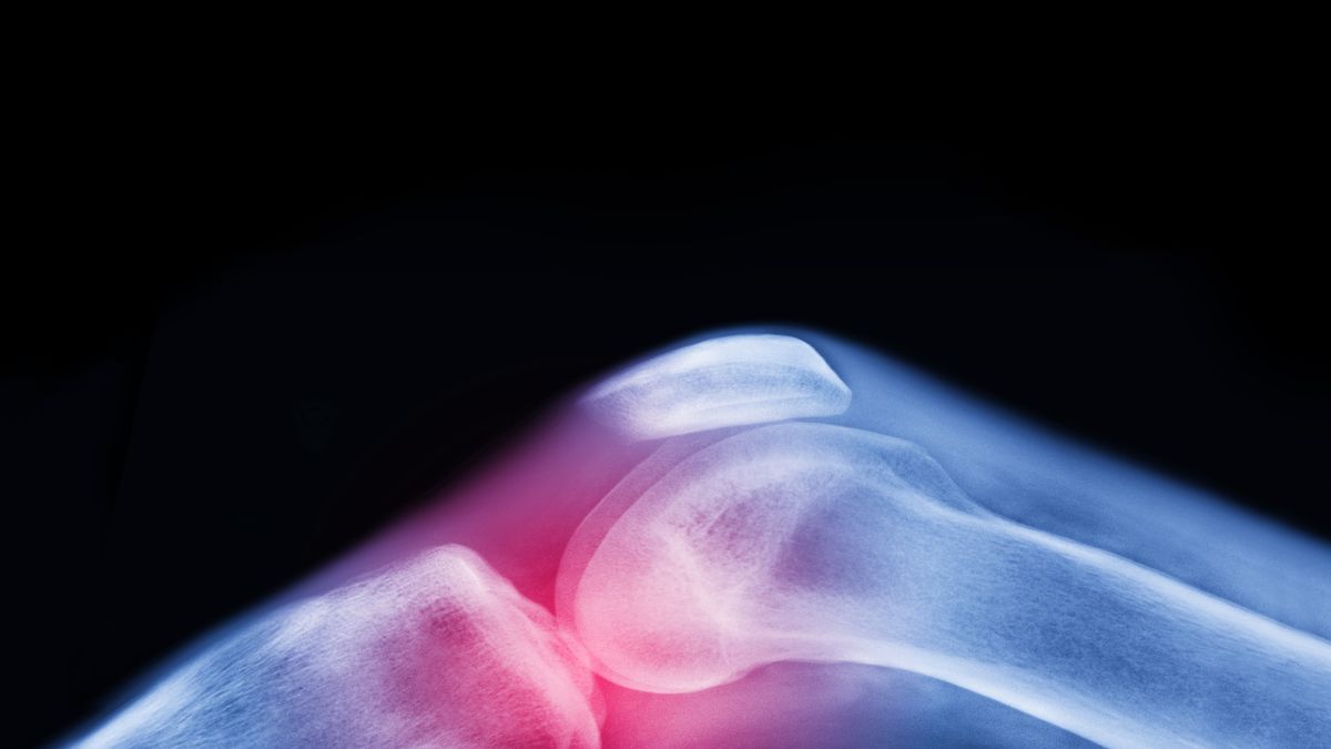 Is Arthritis Preventable? How Experts Say You Can Reduce Risk - The New  York Times