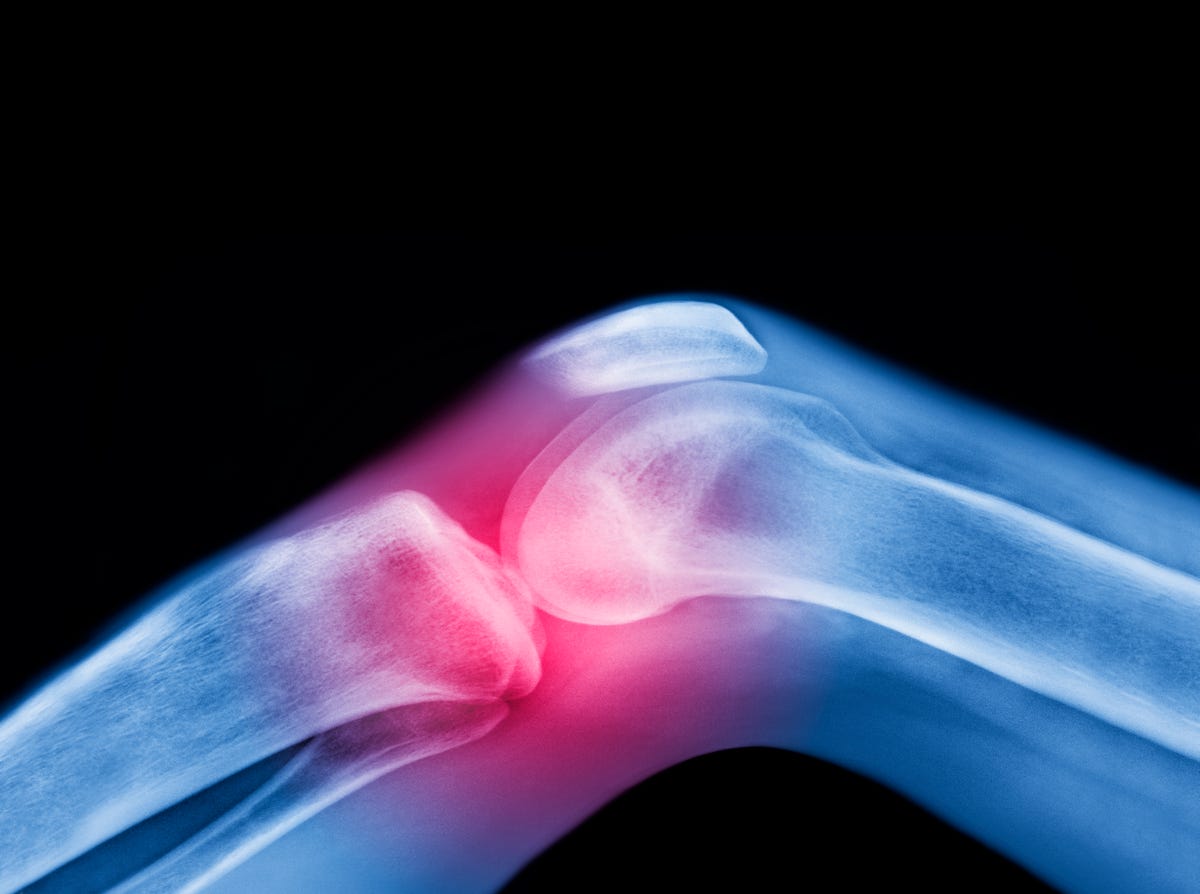 Is Arthritis Preventable? How Experts Say You Can Reduce Risk - The New  York Times