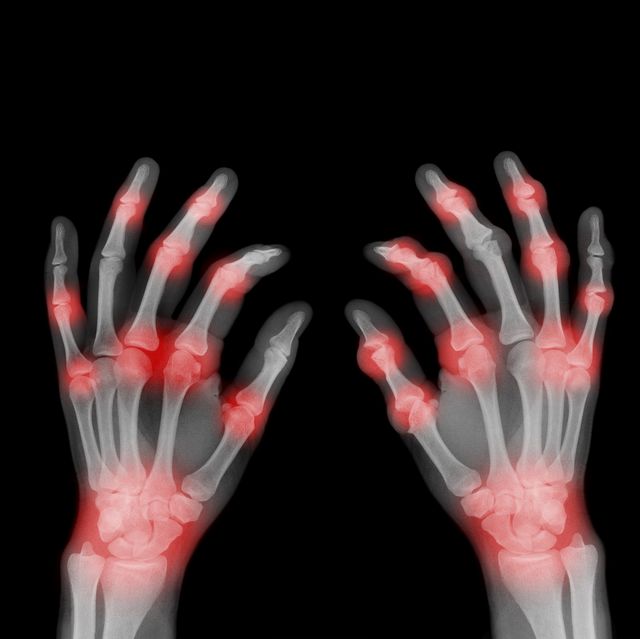 éponge écraser écorce pain in joints of hands and legs Gardien