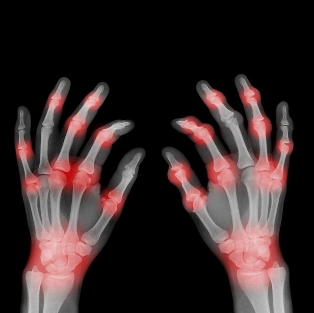 x ray of painful hands