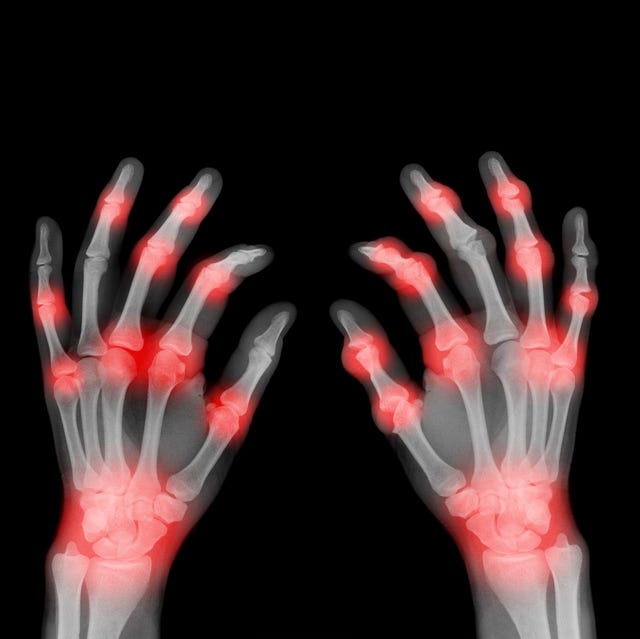 x ray of painful hands