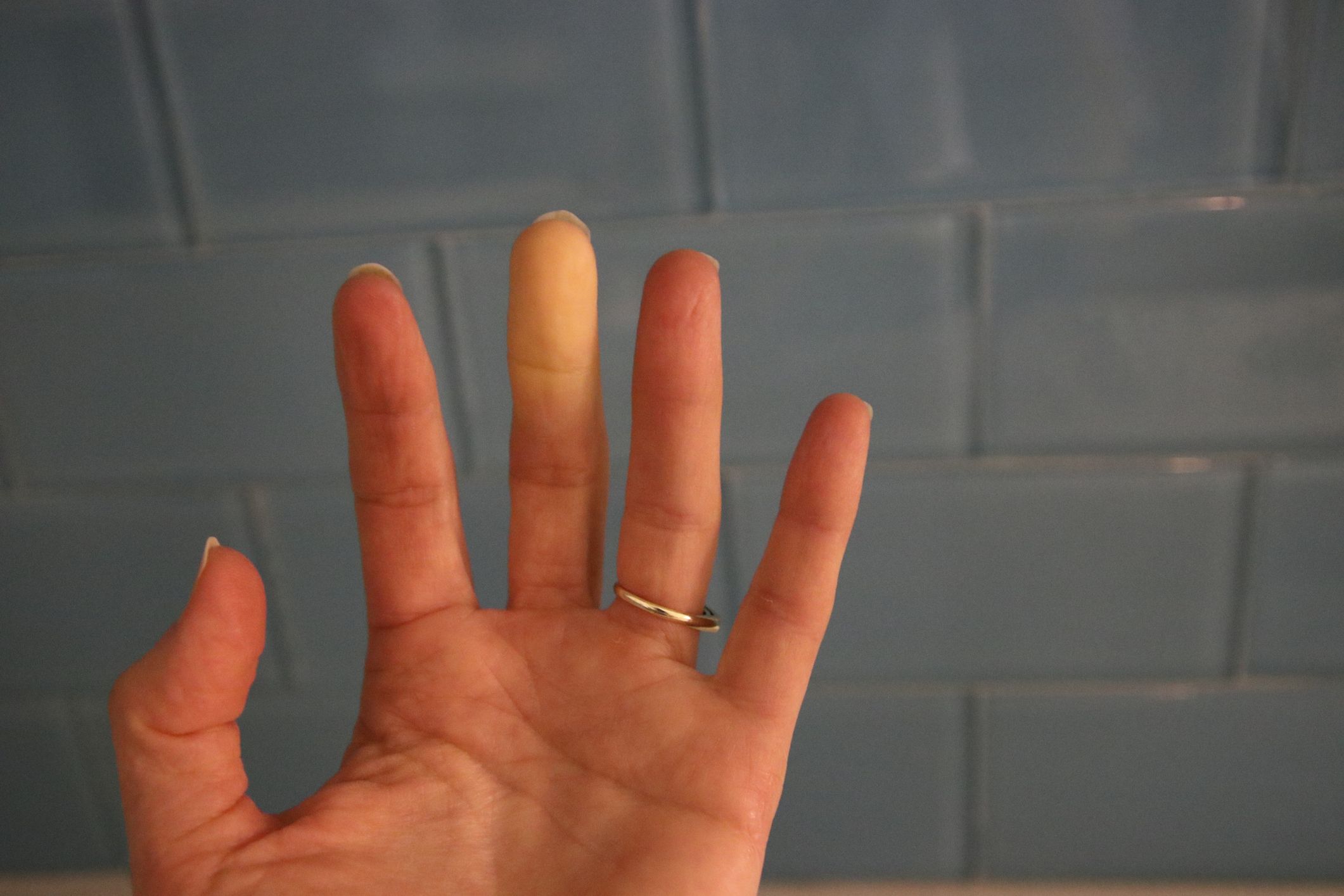 Swollen Fingers: Causes, Risks