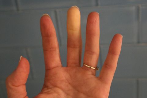Raynaud’s Syndrome Phenomena Adult Hand