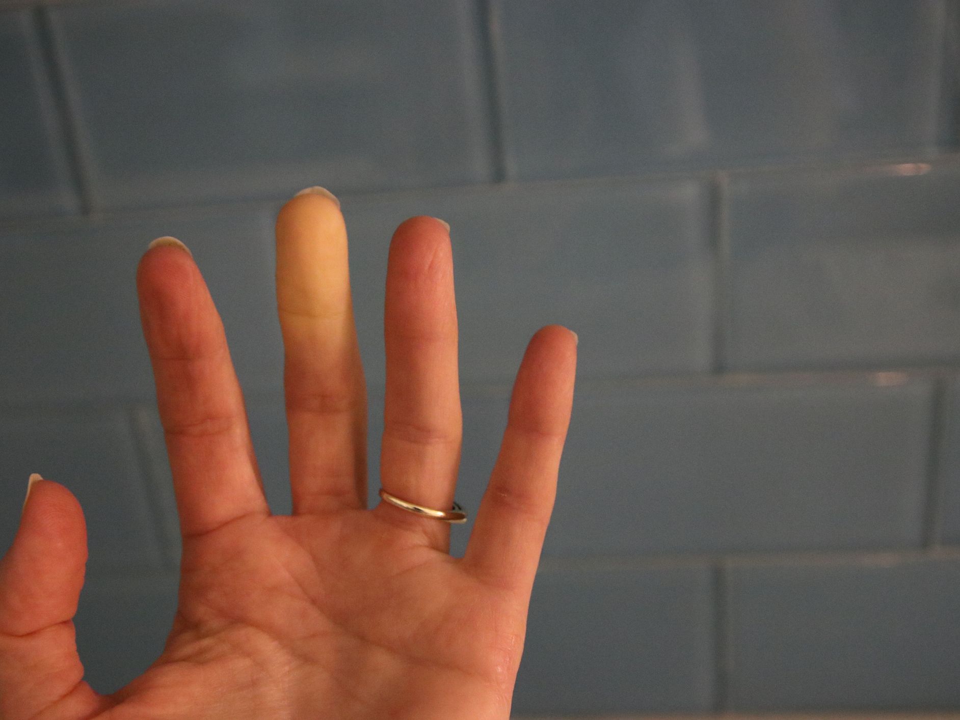 lupus rash on hands