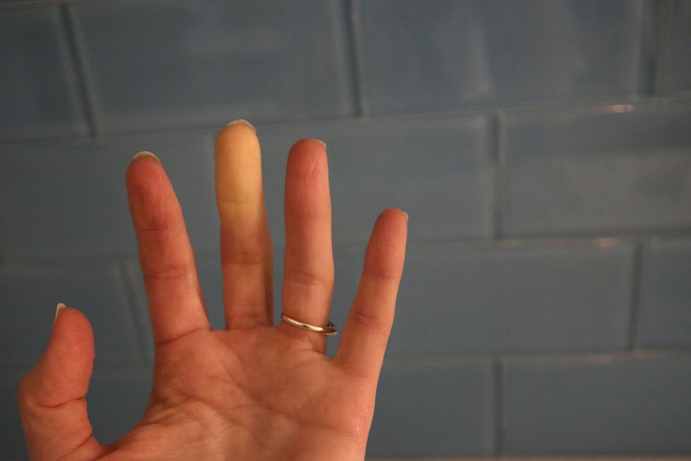 raynaud’s syndrome phenomena adult hand