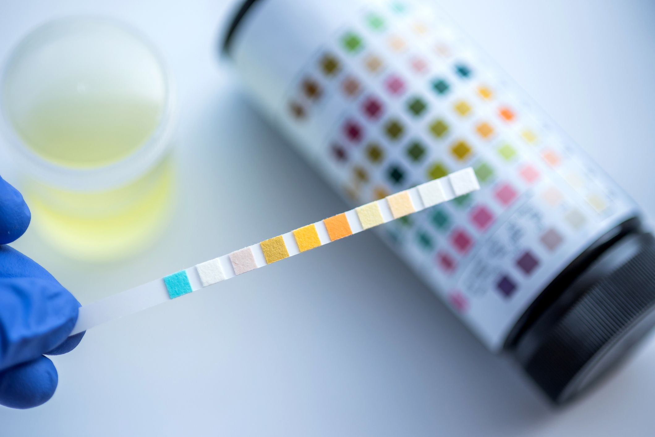 Pee Colour Meaning: Urine Chart Infection, Dehydration