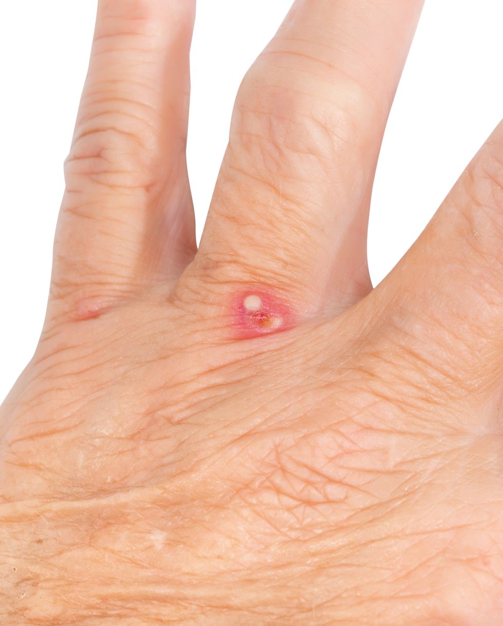 red ant bite on the hand of a female, senior adult near her fingers