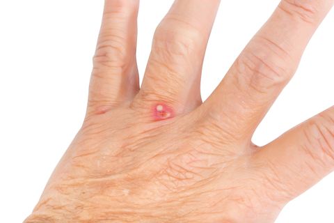 red ant bite on the hand of a female, senior adult near her fingers