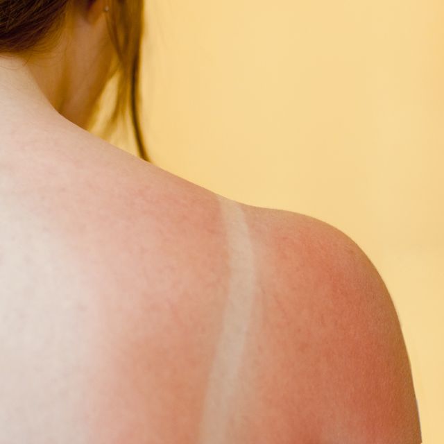 日差しの厳しい季節は、うっかり気を抜くと「日焼けしすぎた！」なんてことも。いざという時のために、自宅で日焼けによる肌トラブルを改善する方法と、普段から実践すべき日焼けの予防法を専門家たちが伝授します！