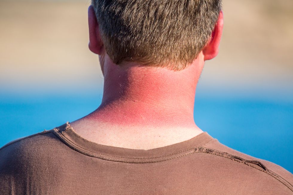 red sunburnt neck from too much sun australia