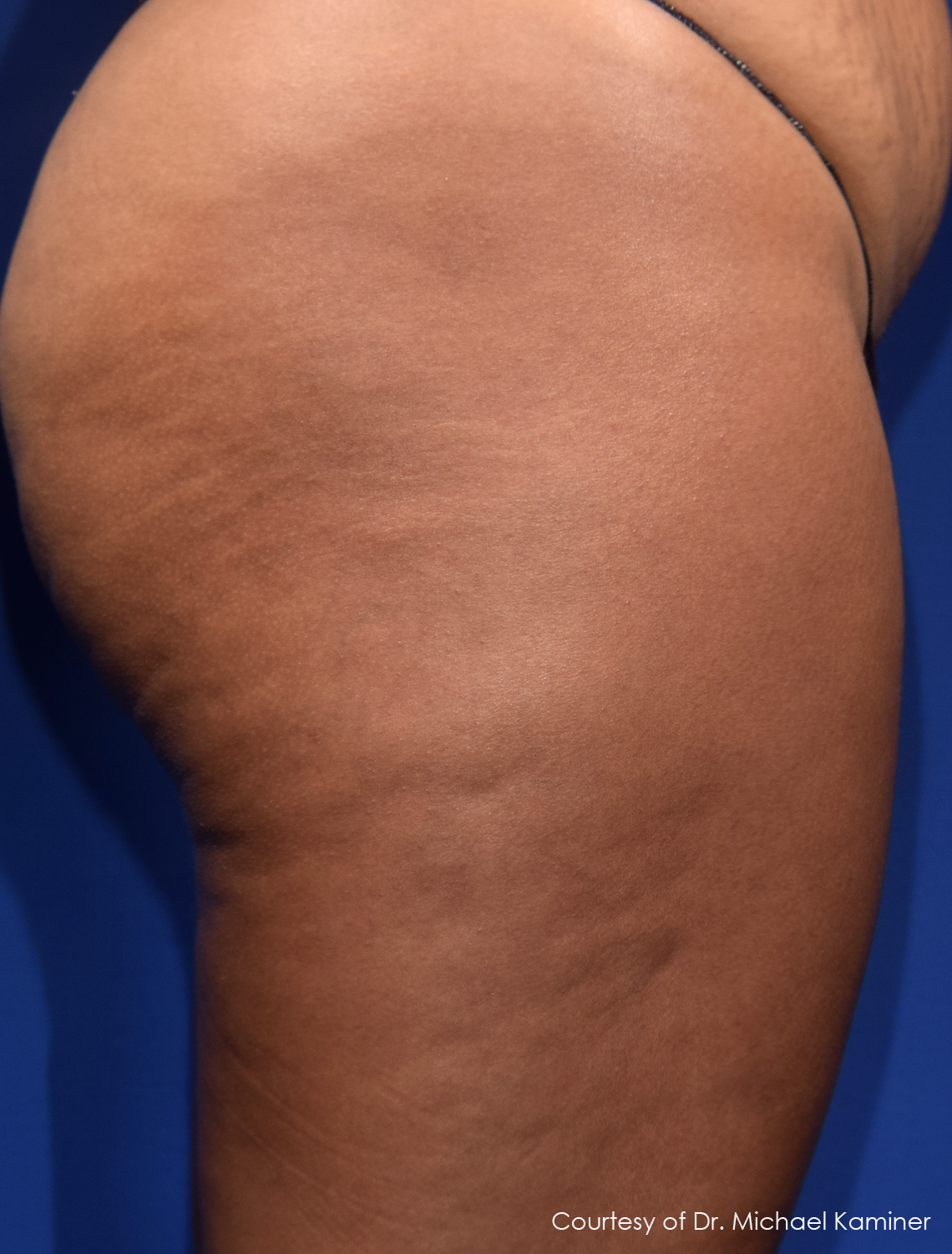 Your Guide to the New Cellulite Treatment Resonic