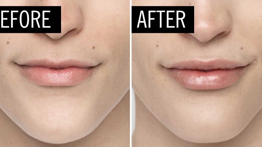 8 Common Myths About Lip Injections And