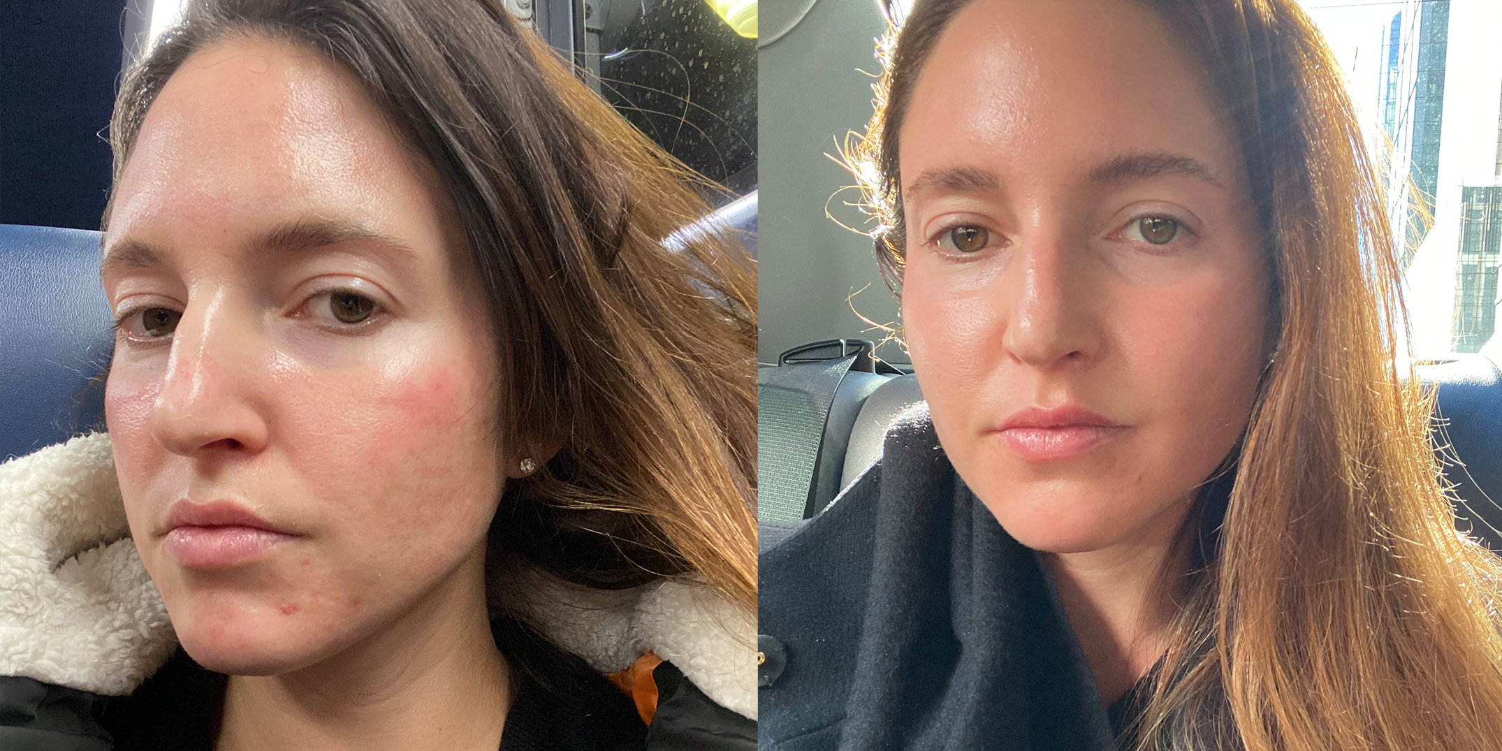 Morpheus8 Review 2023: I Tested The RF Microneedling Treatment