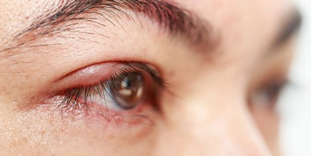 Болят глаза причины лечение. Блефарит конъюнктивит ячмень.