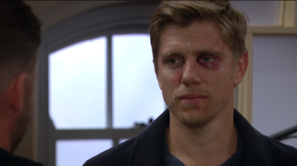 a closeup of robert sugden sporting a black eye, emmerdale