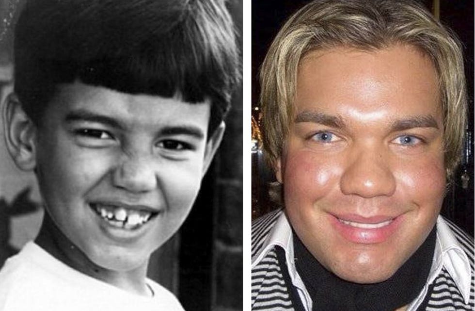 rodrigo alves, ken humano, antes de sus operaciones estéticas