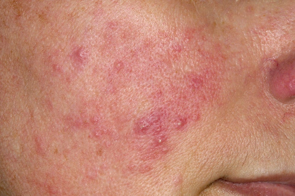 Rosacea rosacea