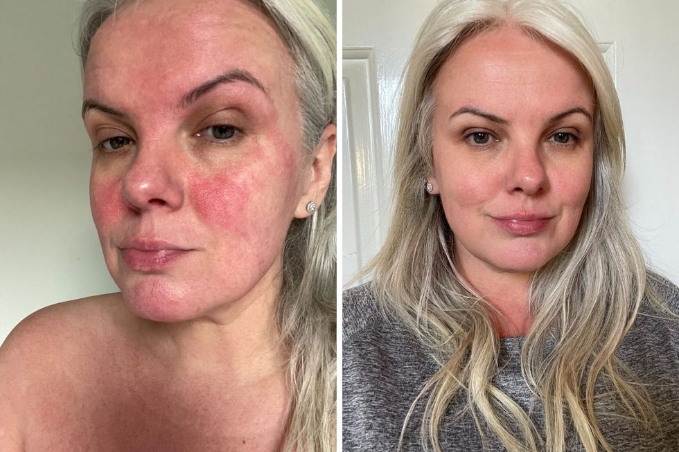 how to cope with rosacea