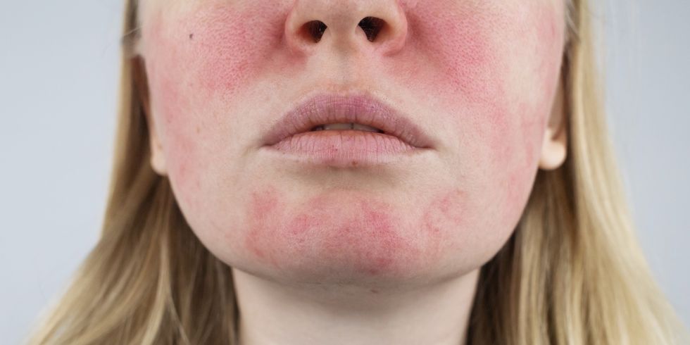 rosacea face the girl suffers from redness on her cheeks couperosis of the skin redness and capillary mesh are visible on the face treatment and removal vascular surgery and dermatology