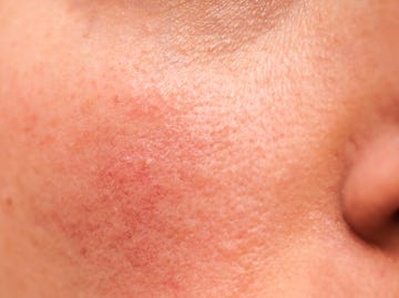 rosacea on skin