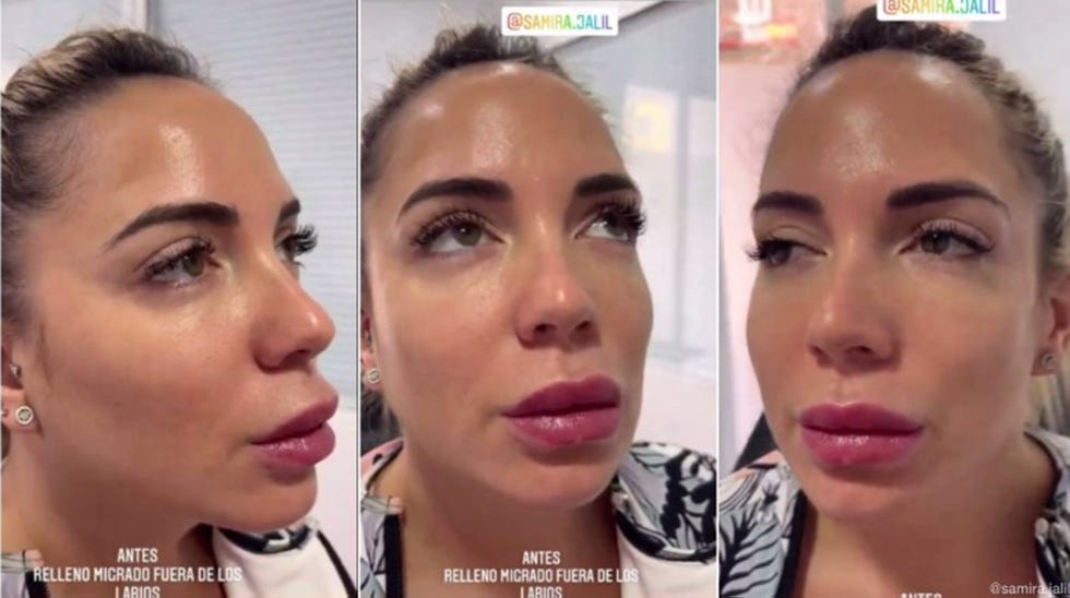 samira jalil muestra sus labios hinchados antes de eliminar el relleno﻿