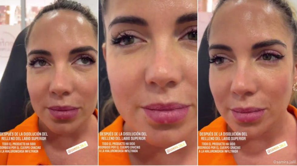 samira jalil muestra sus labios tras eliminar el relleno