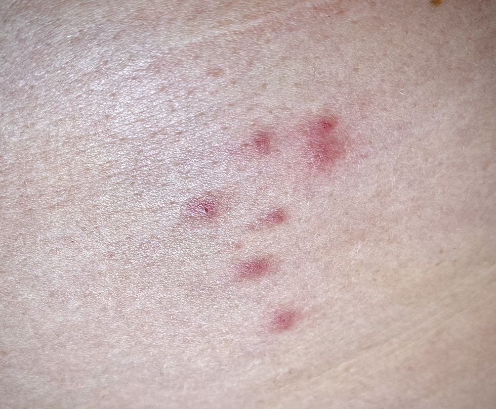 sand fly bites