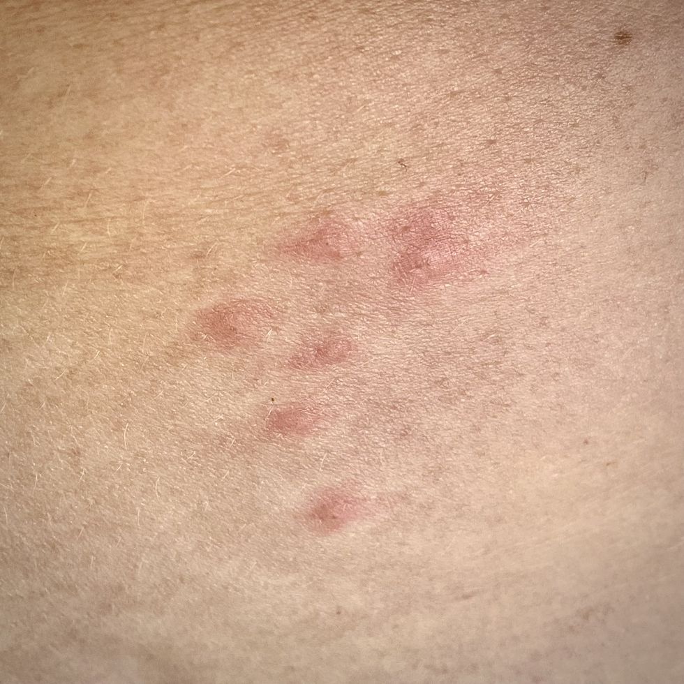 sandfly bites