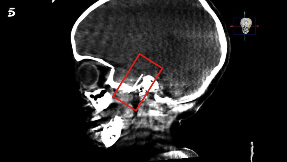 radiografiia de sara, la nina a la que han tenido que operar para extraer una aguja de su cerebro