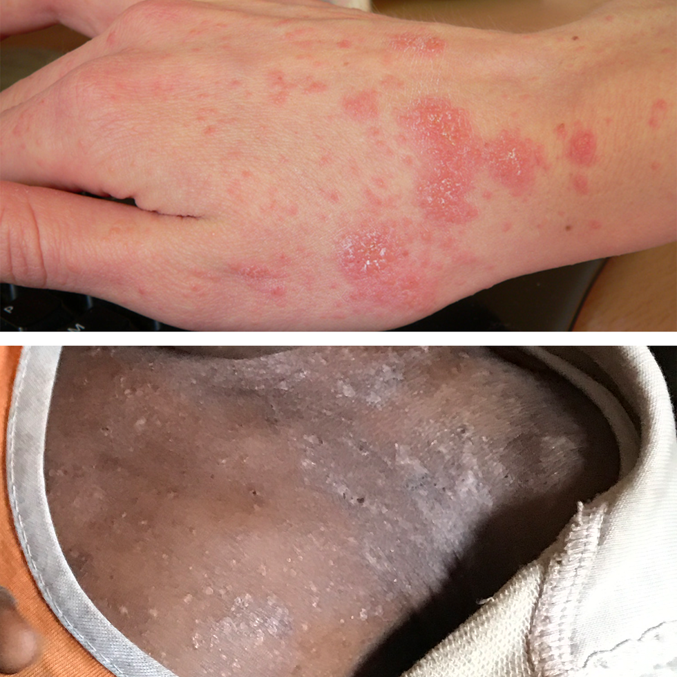 Allergy rash on skin leg caused by bug bites from topical beach sand Stock  Photo