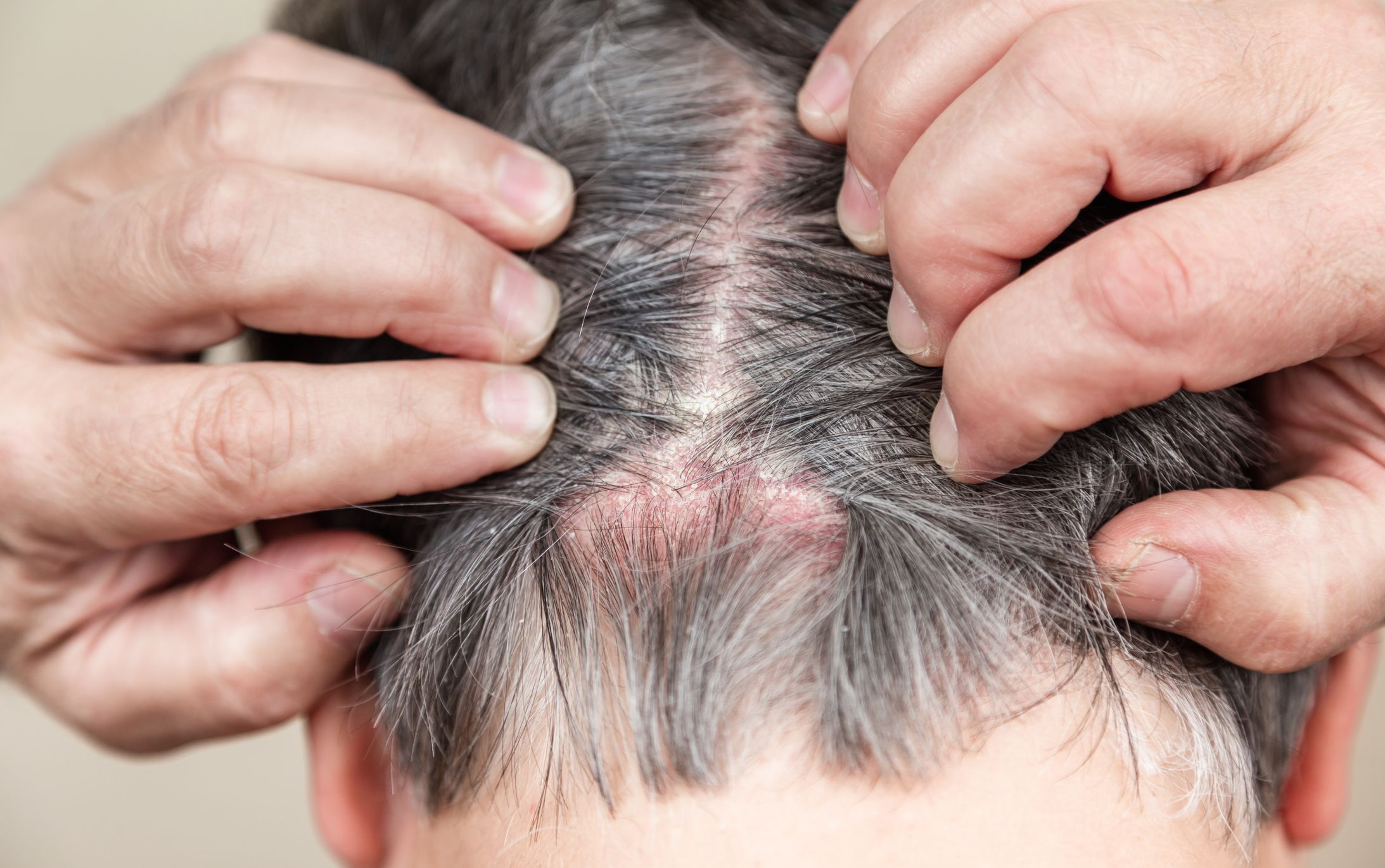 Scalp Psoriasis Vs. Dandruff: What’s The Difference?