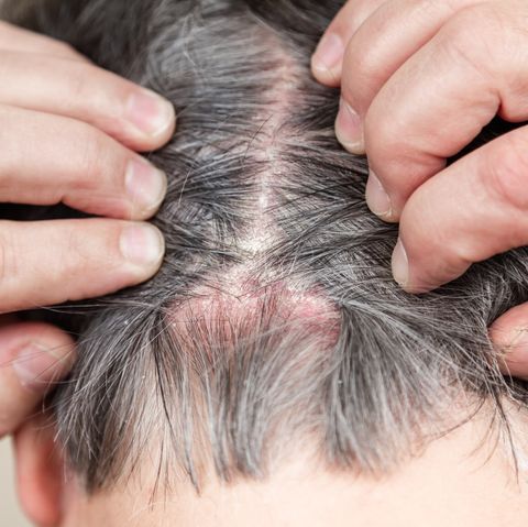 head psoriasis head psoriasis psoriasis vulgaris, psoriatic skin disease in hair, skin patches are typicaly red, itchy, and scaly, macro with narrow focus