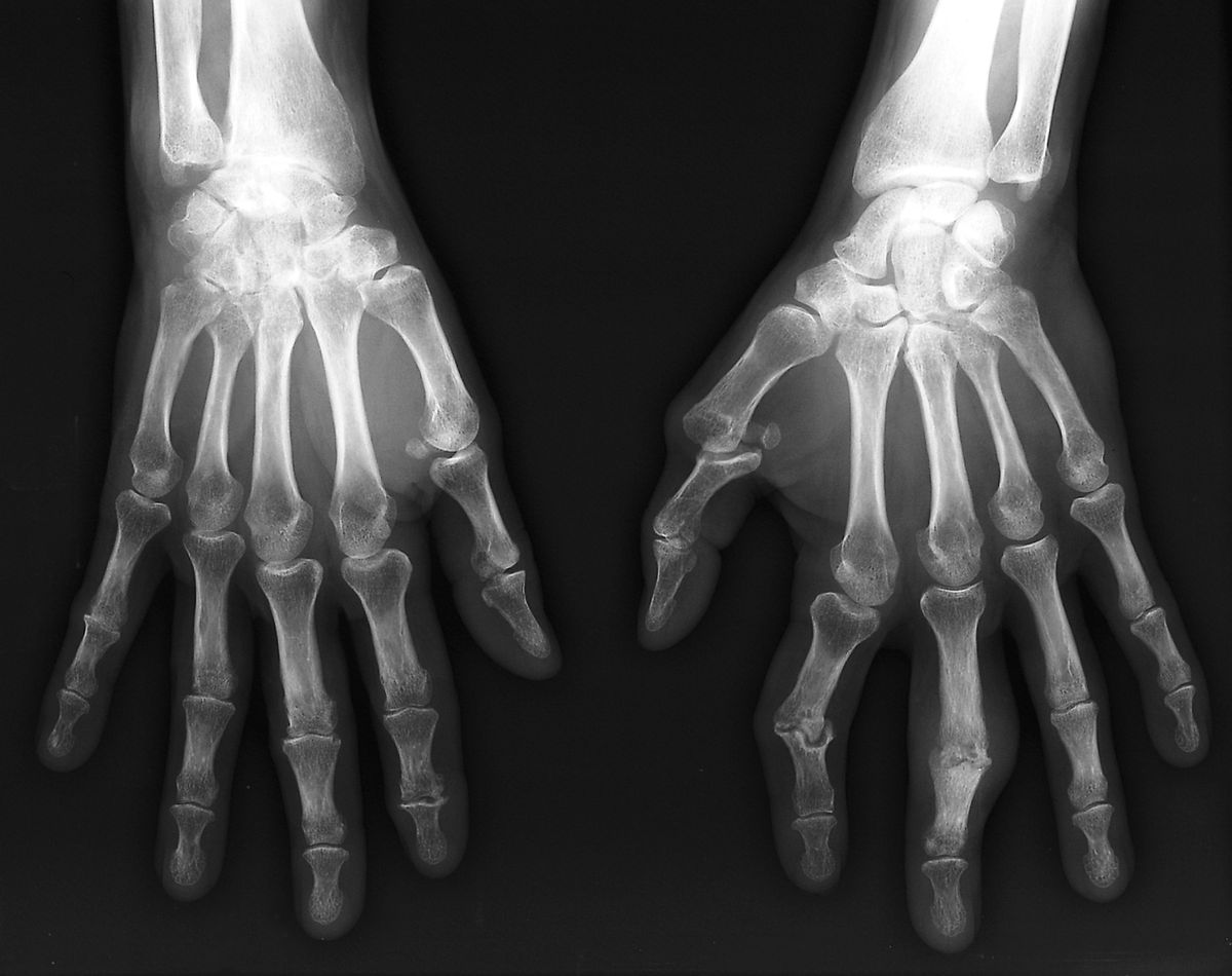 Rntgenopnamen van beide handen en polsen van een 54jarige patint met reumatode artritis Op de foto van de rechterhand links zijn de symptomen van artritis in de polsgewrichten te herkennen De holle ruimten in het botweefsel zijn verkleind en de botten beginnen te vergroeien Bij de linkerhand rechts zijn er op de knokkels benige groeisels te zien die ontstekingen veroorzaken Reumatode artritis is een degeneratieve autoimmuunziekte die vooral het gewrichtskapsel rond synoviale gewrichten aantast en daar chronische ontstekingen veroorzaakt De ziekte kan invaliderend en pijnlijk zijn en tot misvormingen en het verlies van bewegingsfuncties en mobiliteit leiden
