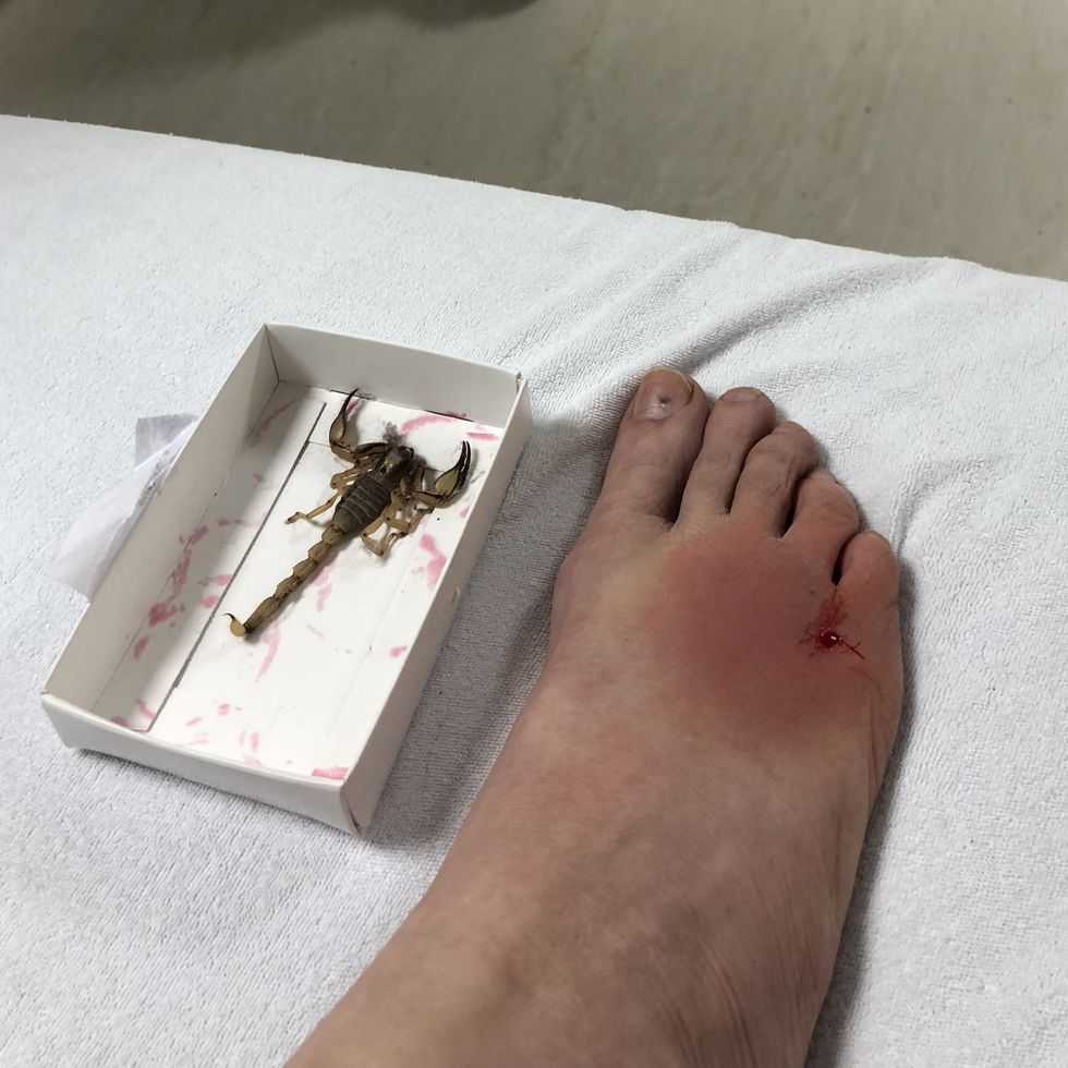 scorpion sting on foot