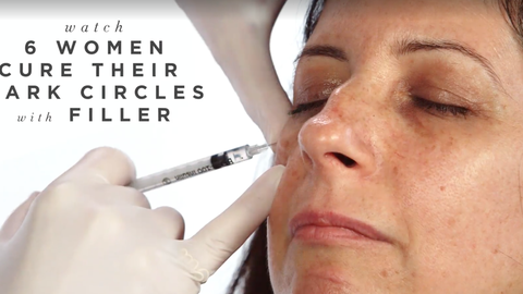 preview for 6 Women Cure Their Dark Circles with Fillers | Harper's BAZAAR
