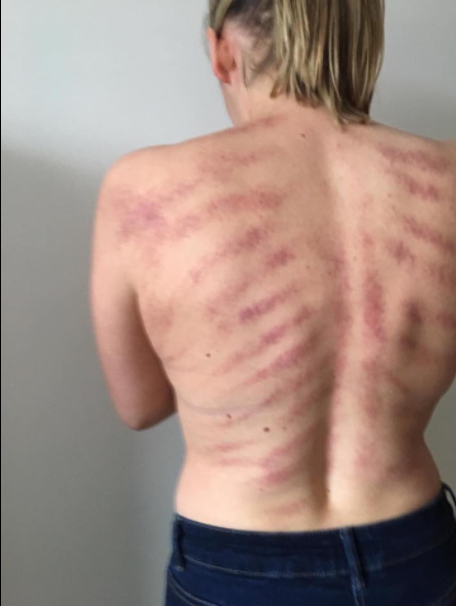 Viral Photos Show Shocking Marks from a Popular Alternative to Cupping