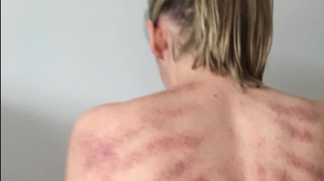 Viral Photos Show Shocking Marks from a Popular Alternative to Cupping