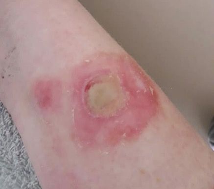 Teens Are Burning Themselves With The 'Deodorant Now