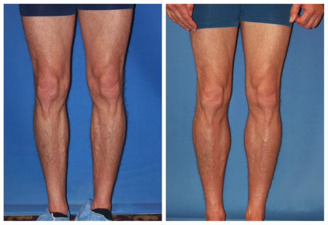 Human leg, Leg, Thigh, Calf, Joint, Knee, Skin, Muscle, Human body, Flesh, 