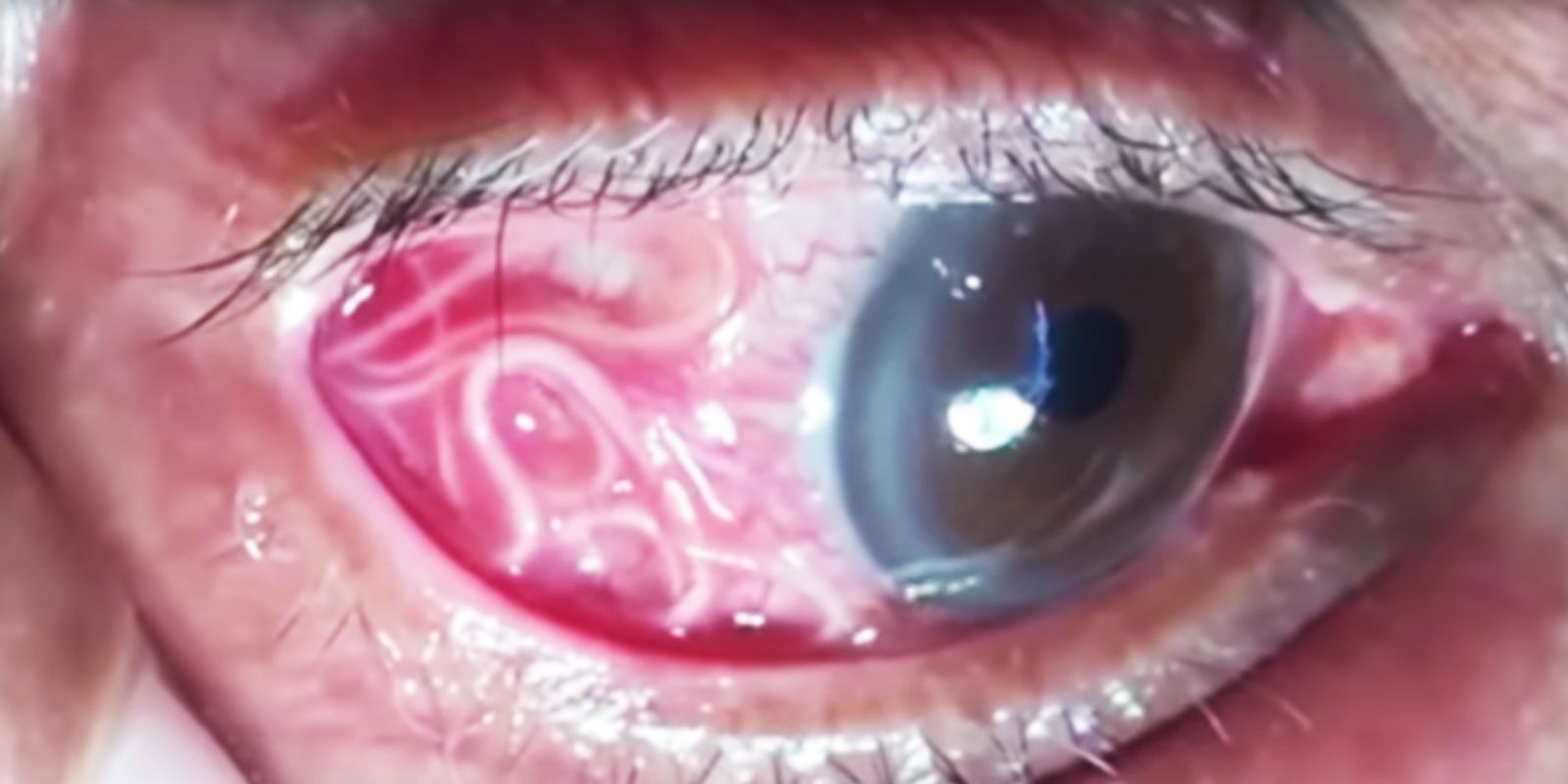 parasite in human eye