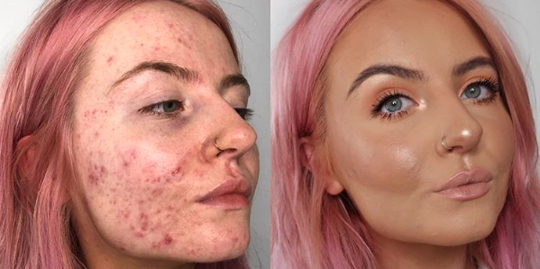 how to cover acne scars without makeup