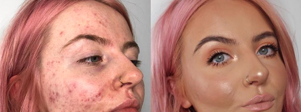Cystic Acne Sufferer