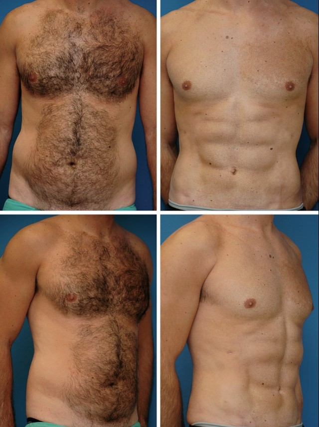 abdominal etching before and after