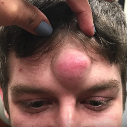 emulsion Stejl lærling Dr. Pimple Popper Pops 6-Year-Old "Unicorn Cyst" On Man's Forehead
