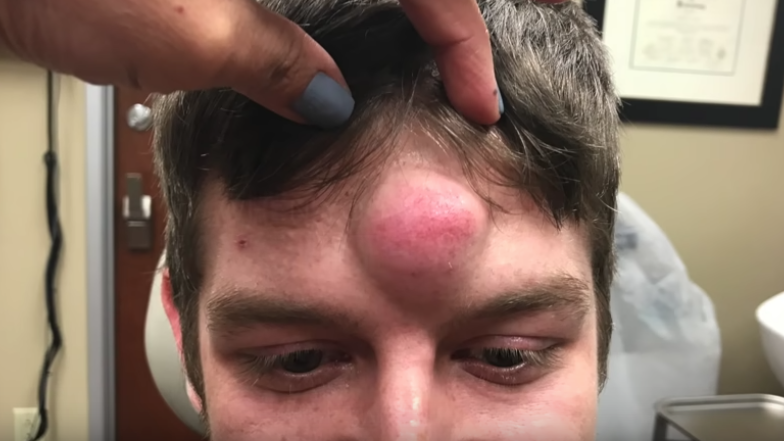 scalp pimple pop
