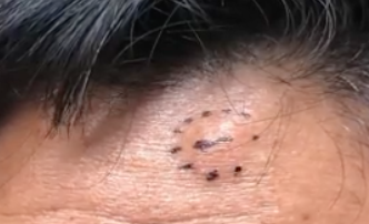 giant pimple on forehead