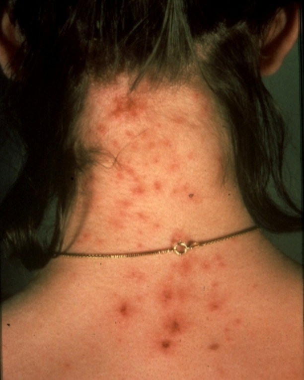 what do head lice bites look like