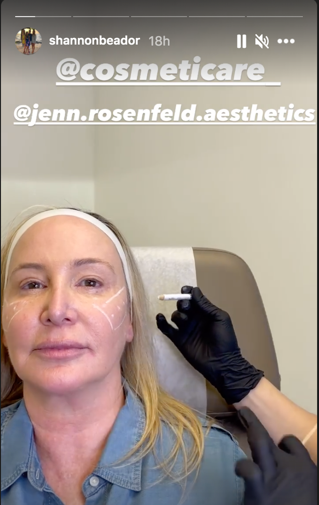 RHOC’s Shannon Beador on Why She Had Face Fillers Dissolved